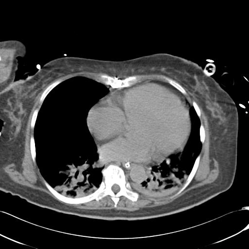 File:Bladder rupture post renal biopsy (Radiopaedia 30863-31572 Axial non-contrast 2).jpg