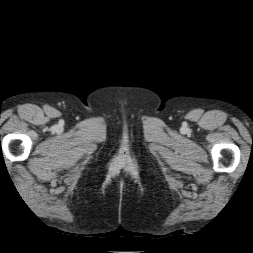 Bladder tumor detected on trauma CT (Radiopaedia 51809-57609 C 154).jpg