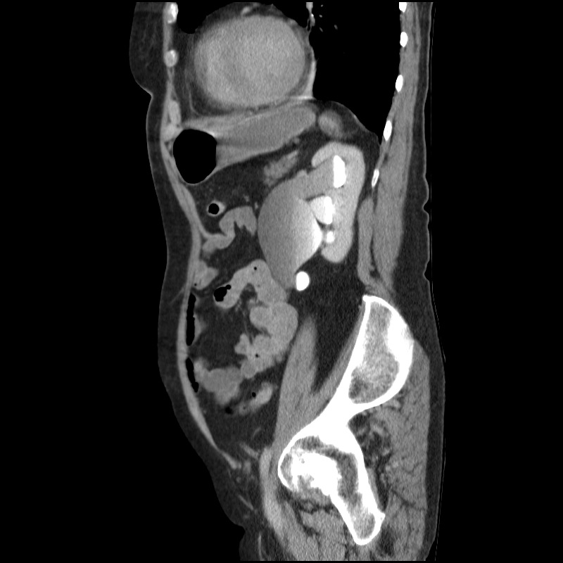 Bladder tumor detected on trauma CT (Radiopaedia 51809-57609 E 22).jpg
