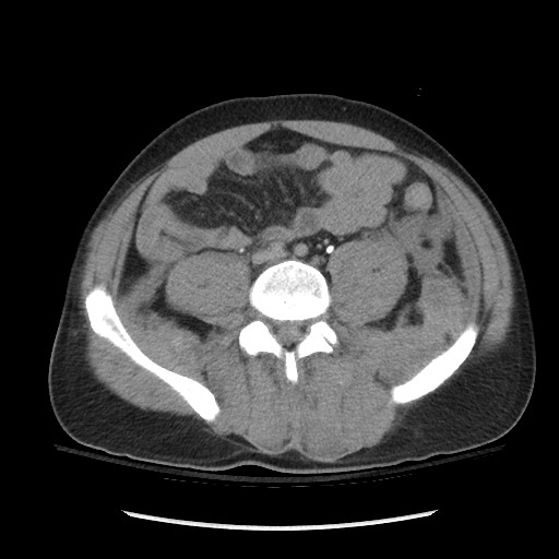 Blunt abdominal trauma with solid organ and musculoskelatal injury with active extravasation (Radiopaedia 68364-77895 Axial C+ delayed 92).jpg