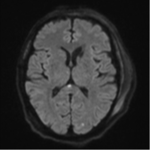 Blunt cerebrovascular injury (Radiopaedia 53682-59745 Axial DWI 47).png