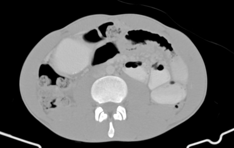 Blunt injury to the small bowel (Radiopaedia 74953-85987 Axial Wide 47).jpg
