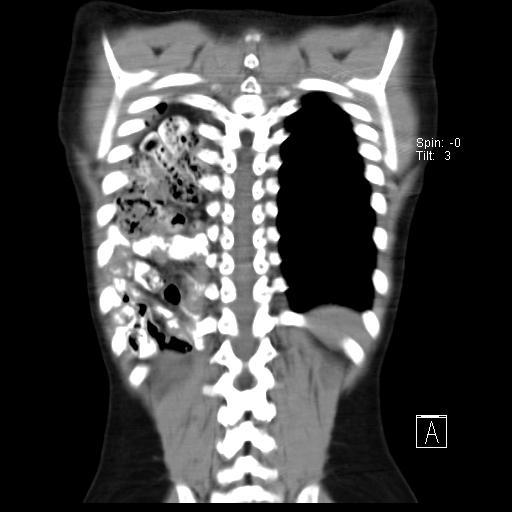 File:Bochdalek diaphragmatic hernia (Radiopaedia 38866-41059 Coronal liver window 18).jpg