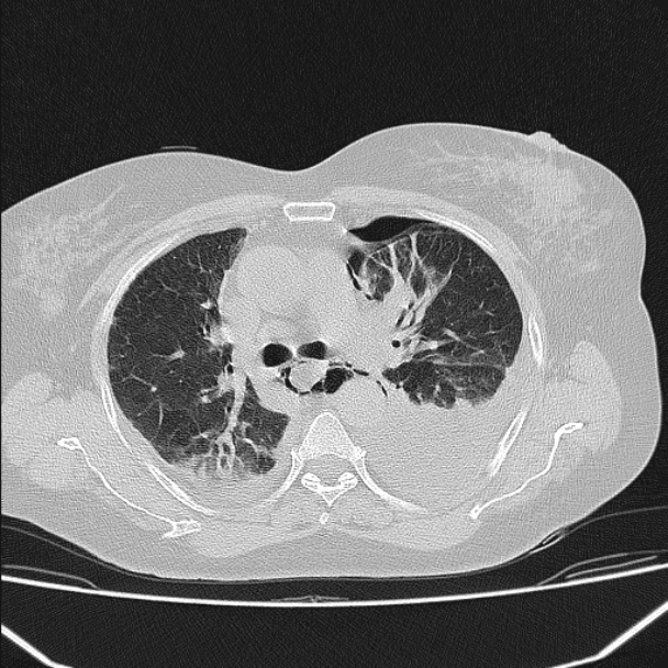 Boerhaave syndrome (Radiopaedia 45644-49799 Axial lung window 54).jpg