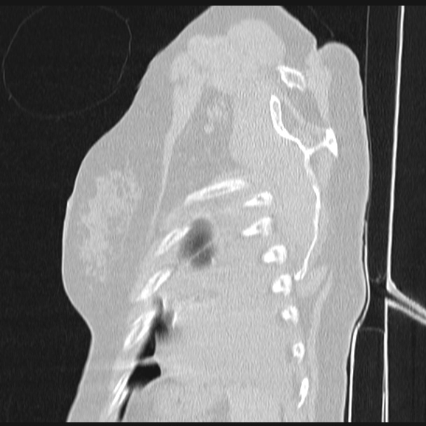 Boerhaave syndrome (Radiopaedia 45644-49799 Sagittal lung window 79).jpg