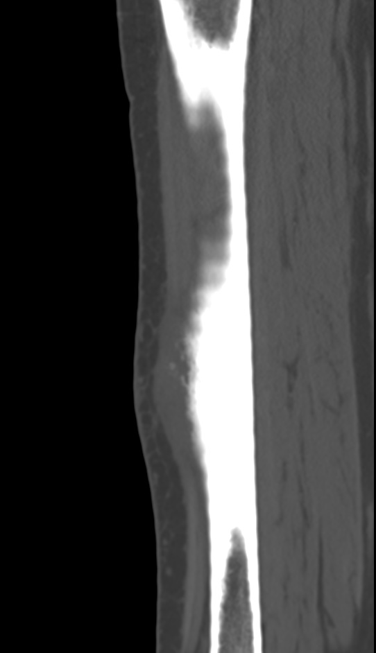 Bone metastasis - tibia (Radiopaedia 57665-64609 Sagittal bone window 107).jpg