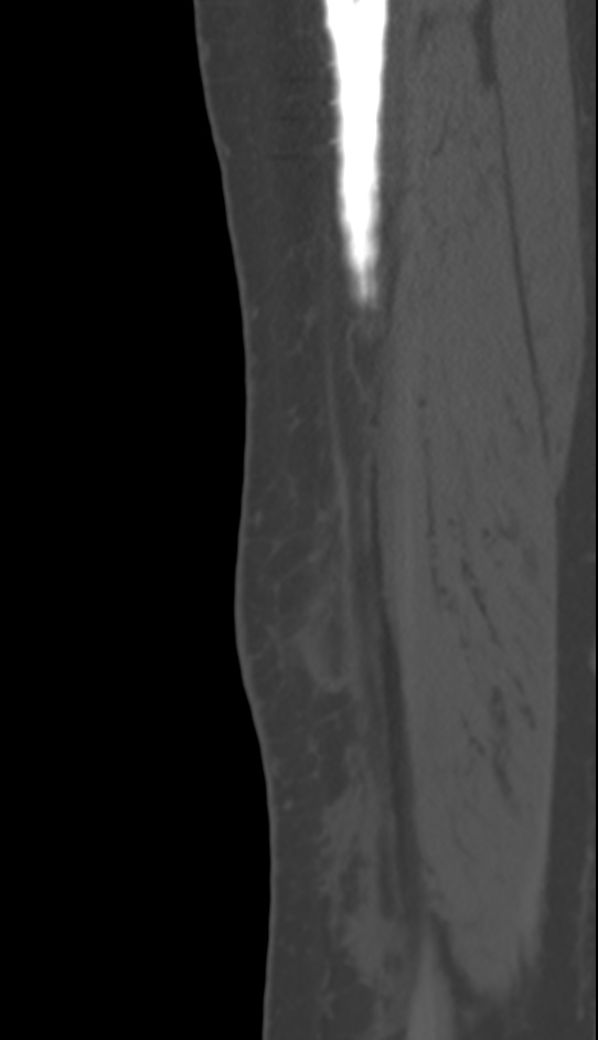 Bone metastasis - tibia (Radiopaedia 57665-64609 Sagittal bone window 30).jpg