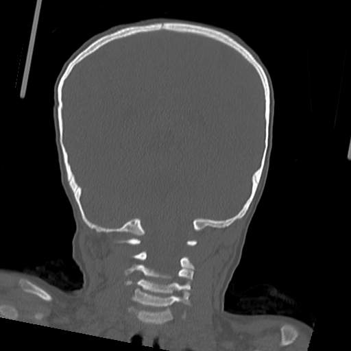 File:Bony atresia of the right external auditory canal (Radiopaedia 27916-28156 Coronal bone window 1).jpg