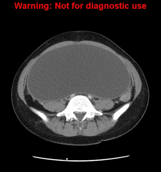 Borderline mucinous cystadenoma of ovary (Radiopaedia 25586-25767 A 57).jpg
