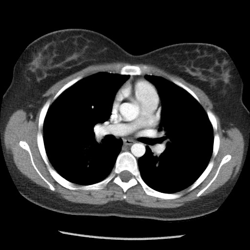 Borderline mucinous tumor (ovary) (Radiopaedia 78228-90808 A 22).jpg