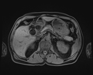 Bouveret syndrome (Radiopaedia 61017-68856 Axial T1 fat sat 30).jpg