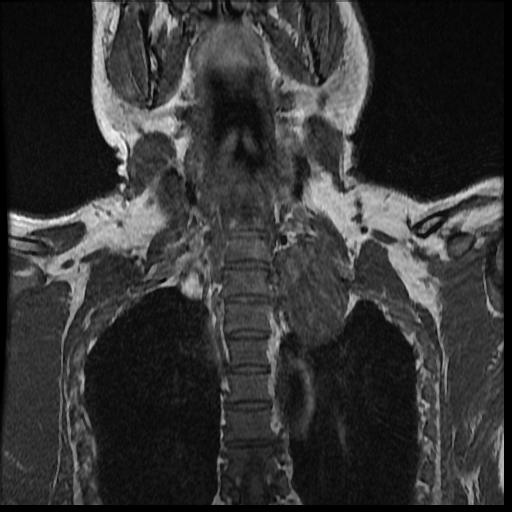 File:Brachial plexus neurofibroma (Radiopaedia 28030-28291 Coronal T1 6).png