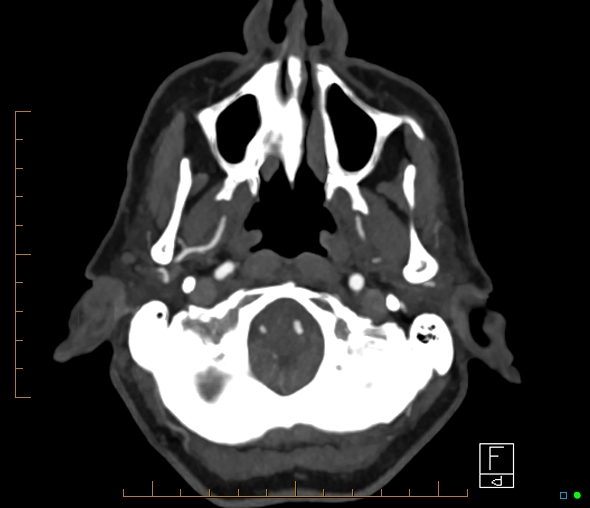 File:Brachiocephalic trunk stenosis (Radiopaedia 87242-103519 A 63).jpg