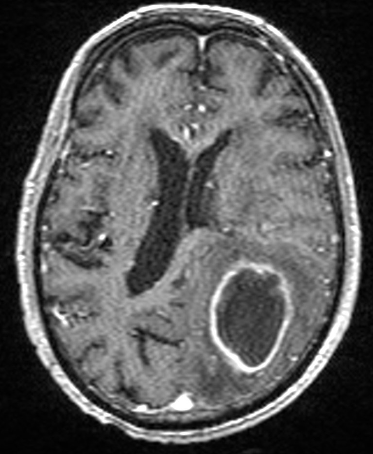 Brain abscess with dual rim sign (Radiopaedia 87566-103938 Axial T1 C+ 99).jpg