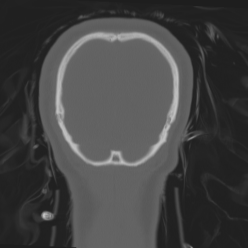 File:Brain contusions, internal carotid artery dissection and base of skull fracture (Radiopaedia 34089-35339 Coronal bone window 62).png