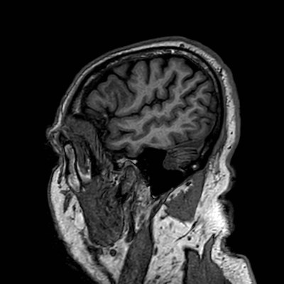 Brain metastases from lung cancer (Radiopaedia 83839-99028 Sagittal T1 17).jpg