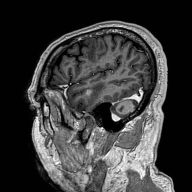 Brain metastases from lung cancer (Radiopaedia 83839-99028 Sagittal T1 C+ 54).jpg