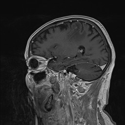 Brain metastasis (Radiopaedia 42617-45761 Sagittal T1 C+ 32).jpg