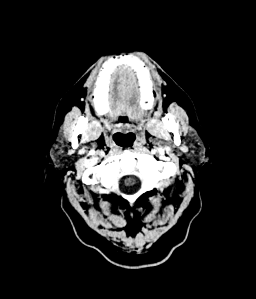 Brain metastasis (large cystic mass) (Radiopaedia 47497-52106 Axial C+ 7).png