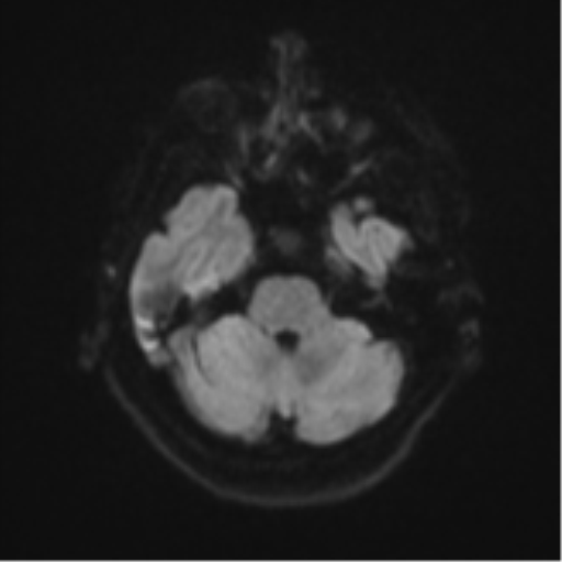 Brain metastasis (sarcoma) (Radiopaedia 47576-52209 Axial DWI 36).png