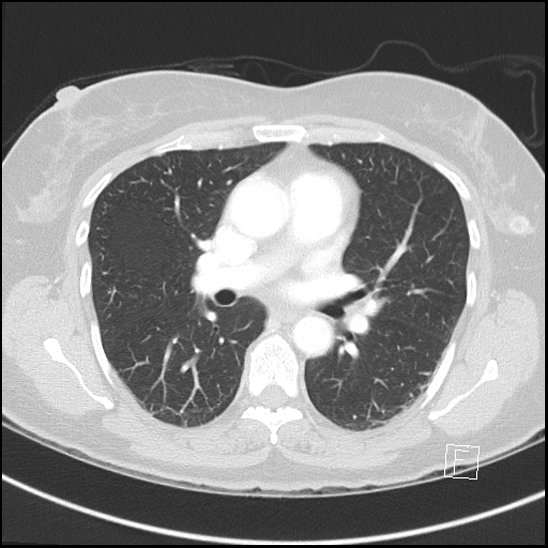 File:Breast metastases from renal cell cancer (Radiopaedia 79220-92225 Axial lung window 40).jpg