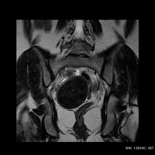 File:Broad ligament fibroid (Radiopaedia 49135-54241 Coronal T2 18).jpg