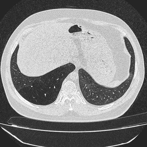 File:Bronchial atresia (Radiopaedia 58271-65417 Axial lung window 42).jpg