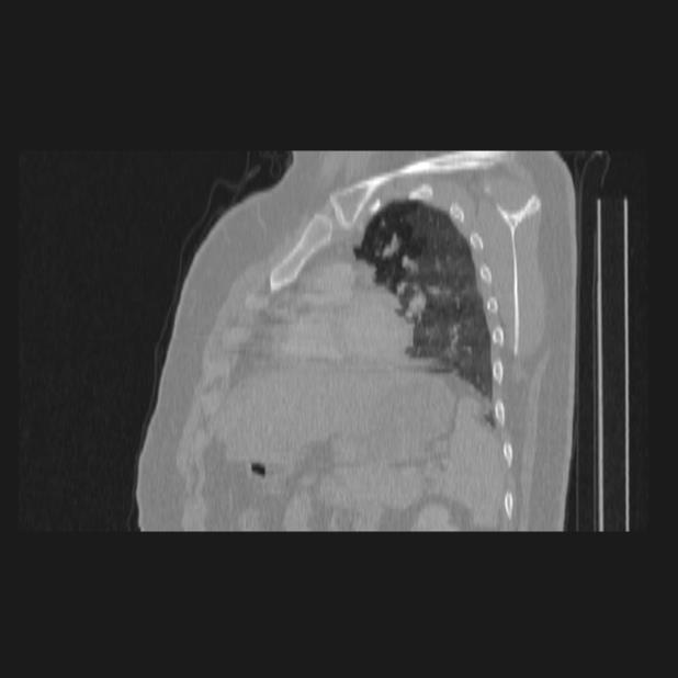 Bronchial atresia (Radiopaedia 60685-68439 Sagittal lung window 63).jpg