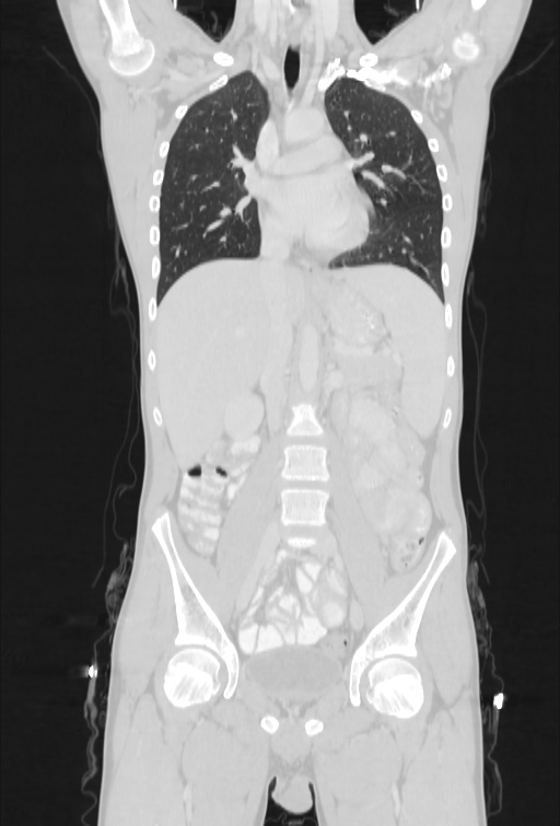 Bronchial carcinoid tumor (Radiopaedia 57187-64090 Coronal lung window 44).jpg