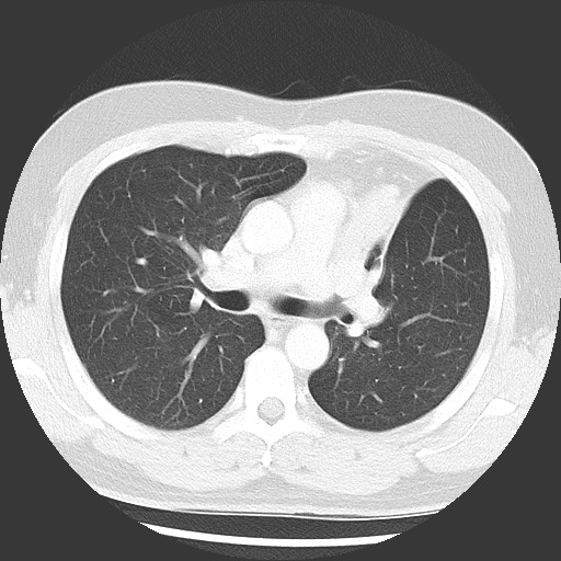 Bronchial carcinoid tumor (Radiopaedia 67377-76764 Axial lung window 28).jpg