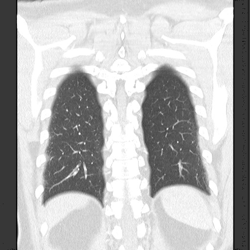 Bronchial carcinoid tumor (Radiopaedia 67377-76764 Coronal lung window 52).jpg
