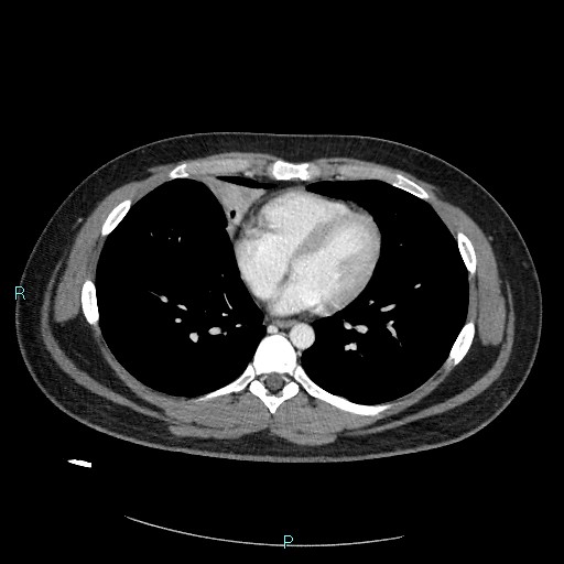 Bronchial carcinoid tumor (Radiopaedia 78272-90875 A 62).jpg