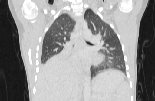 Bronchial mucoepidermoid carcinoma (Radiopaedia 57023-63895 Coronal lung window 26).jpg