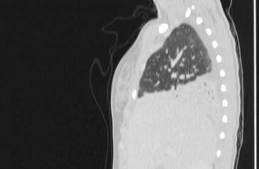 File:Bronchial mucoepidermoid carcinoma (Radiopaedia 57023-63895 Sagittal lung window 19).jpg