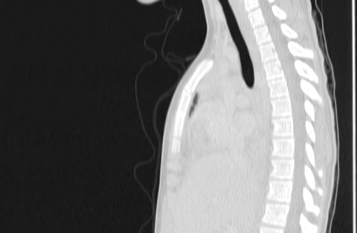 Bronchial mucoepidermoid carcinoma (Radiopaedia 57023-63895 Sagittal lung window 74).jpg