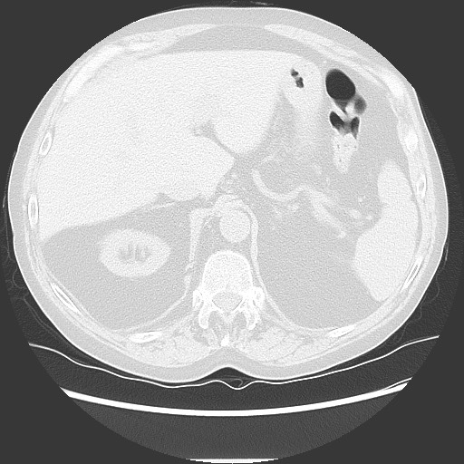 Bronchial stenosis - lung transplant (Radiopaedia 73133-83848 Axial lung window 58).jpg