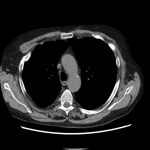 Bronchial stenosis - lung transplant (Radiopaedia 73133-83848 Axial non-contrast 22).jpg
