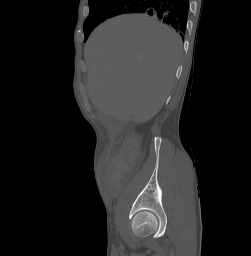 File:Bronchiectasis in Crohn disease (Radiopaedia 60311-67977 Sagittal bone window 22).jpg