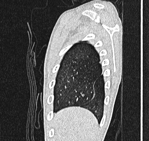 Bronchiolitis obliterans (Radiopaedia 71538-81897 Sagittal lung window 5).jpg