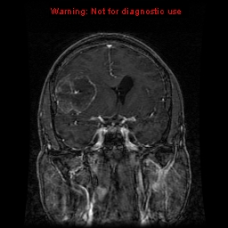 File:Bronchogenic carcinoma brain metastasis (Radiopaedia 9286-9969 Coronal T1 24).jpg