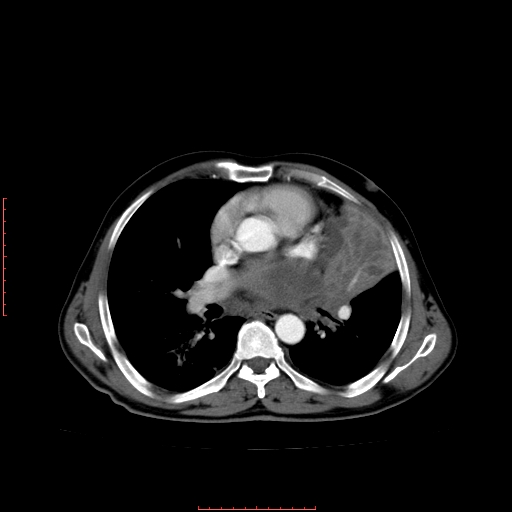 File:Bronchogenic carcinoma with left atrial large deposit - T4N3M1a (Radiopaedia 42316-45428 A 16).jpg