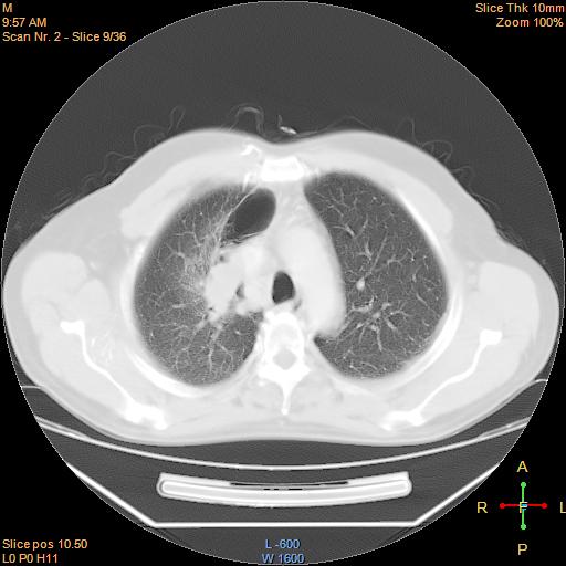 File:Bronchogenic carcinoma with superior vena caval invasion (Radiopaedia 22378-22406 lung window 6).jpg