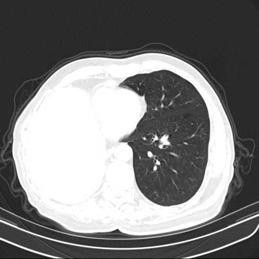 Bronchopleural fistula - postoperative complication (Radiopaedia 21020-20947 Axial lung window 40).jpg