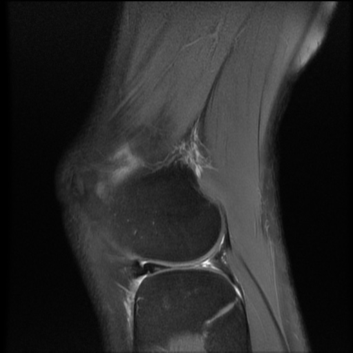 File:Bucket-handle meniscus tear (Radiopaedia 65700-74809 Sagittal PD fat sat 18).jpg