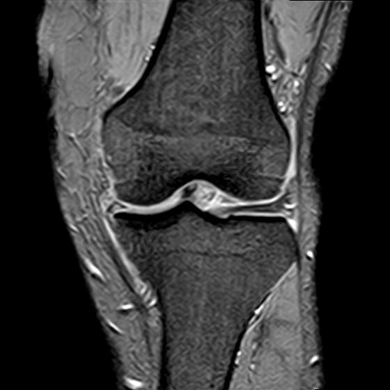 File:Bucket handle tear - medial meniscus (Radiopaedia 29250-29664 B 8).jpg