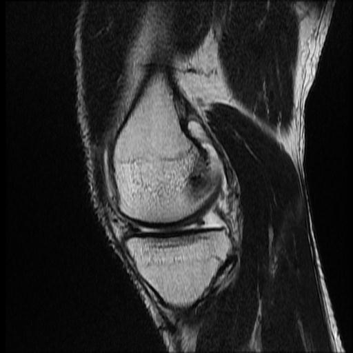 File:Bucket handle tear - medial meniscus (Radiopaedia 69245-79026 Sagittal T2 14).jpg