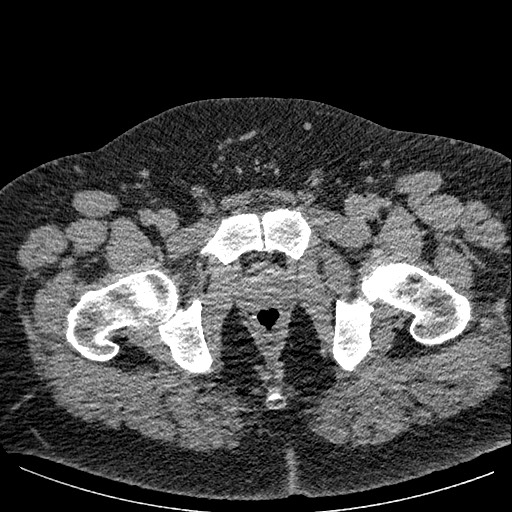 Burned-out testicular seminoma - retroperitoneal nodal metastases (Radiopaedia 62872-71245 A 72).jpg