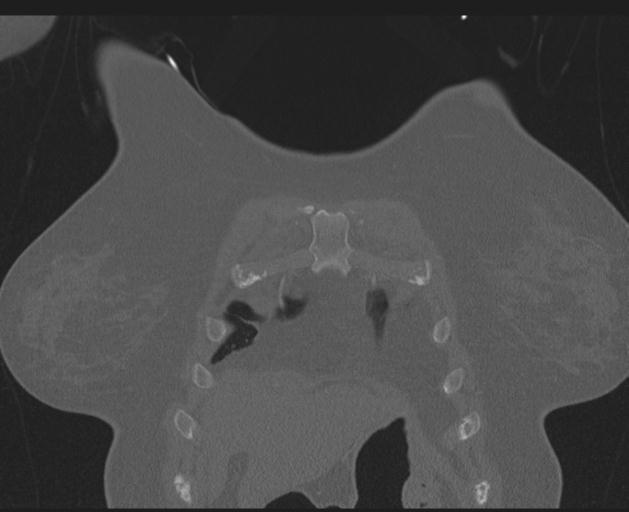 Burst fracture - thoracic spine (Radiopaedia 30238-30865 Coronal bone window 27).jpg