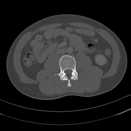 Burst fracture with cauda equina syndrome (Radiopaedia 25701-25867 Axial bone window 84).jpg