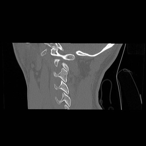 File:C1-C2 "subluxation" - normal cervical anatomy at maximum head rotation (Radiopaedia 42483-45607 C 11).jpg